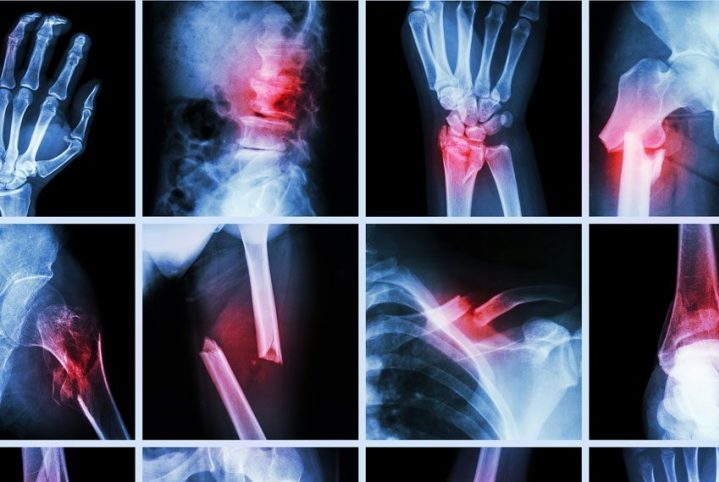 The Bone Splint System: a Revolutionary Treatment for Osteogenesis Imperfecta
