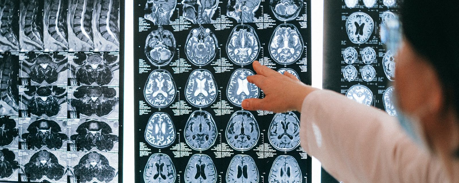 Deep brain stimulation: a potential new treatment for schizophrenia